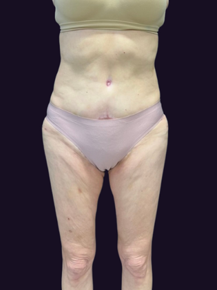 Liposuction Case 7 - Before