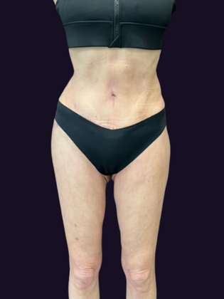 Liposuction Case 7 - After