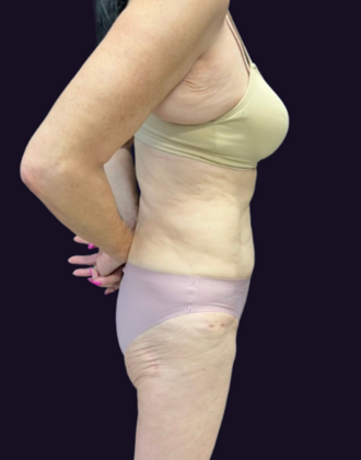 Liposuction: Case 7 - Before