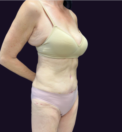 Liposuction: Case 7 - Before