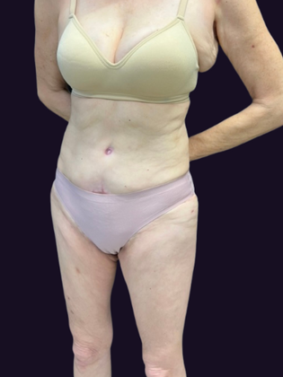Tummy Tuck Case 3 - Before
