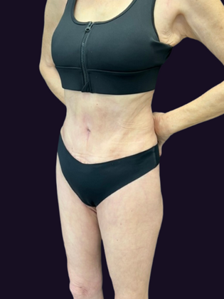 Tummy Tuck Case 3 - After