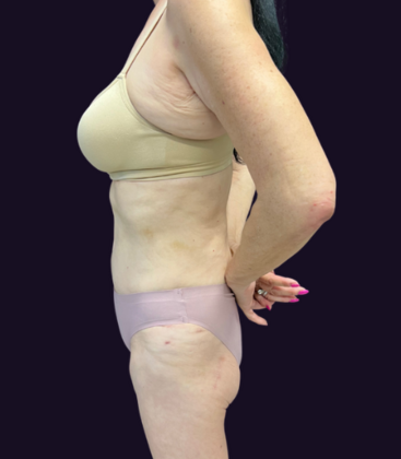 Tummy Tuck: Case 3 - Before