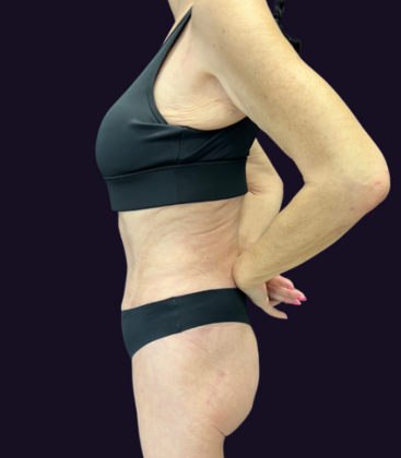 Tummy Tuck: Case 3 - After