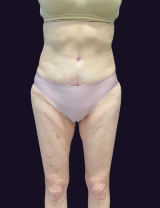 Tummy Tuck: Case 3 - Before