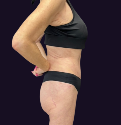 Tummy Tuck: Case 3 - After