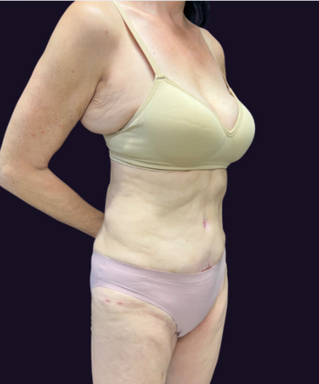 Tummy Tuck: Case 3 - Before