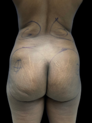 Brazilian Butt Lift Case 7 - Before