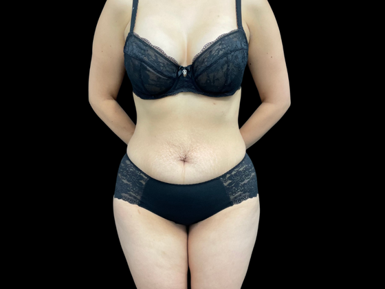 Tummy Tuck Case 4 - Before