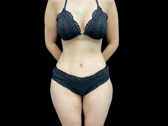 Tummy Tuck Case 4 - After