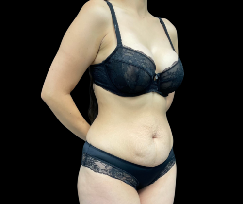 Tummy Tuck: Case 4 - Before