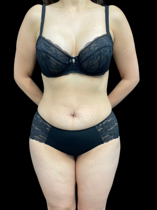 Liposuction Case 8 - Before