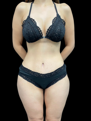 Liposuction Case 8 - After