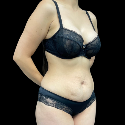 Liposuction: Case 8 - Before