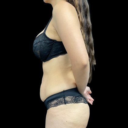 Liposuction: Case 8 - Before