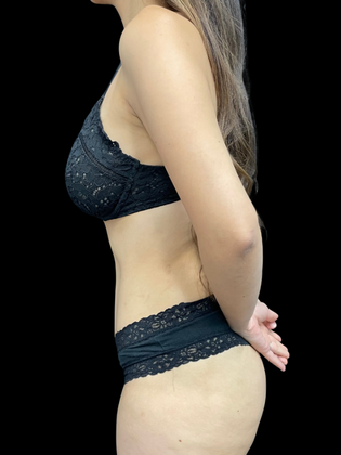 Liposuction: Liposuction 1 - After