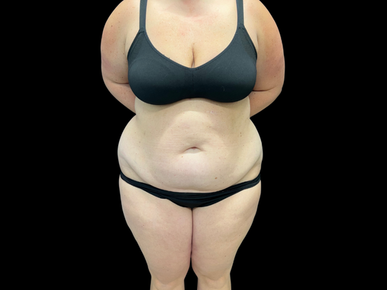 Tummy Tuck Case 5 - Before