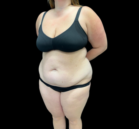 Tummy Tuck: Case 5 - Before