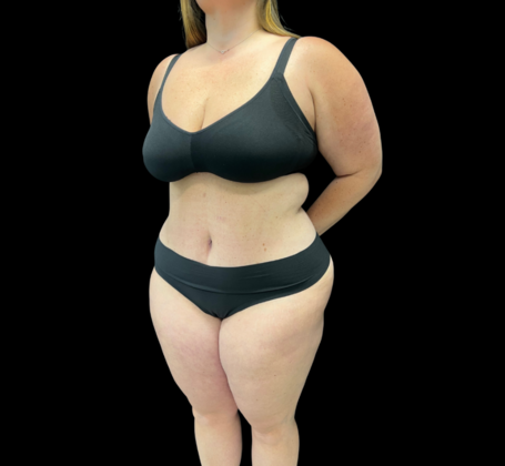 Tummy Tuck: Case 5 - After