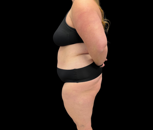 Tummy Tuck: Case 5 - Before