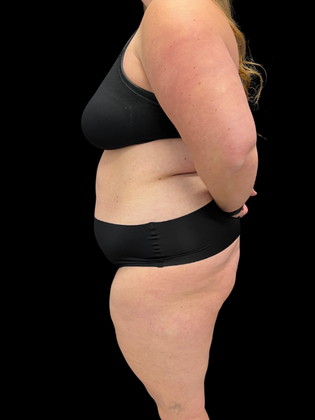 Tummy Tuck Tummy Tuck 4 - Before