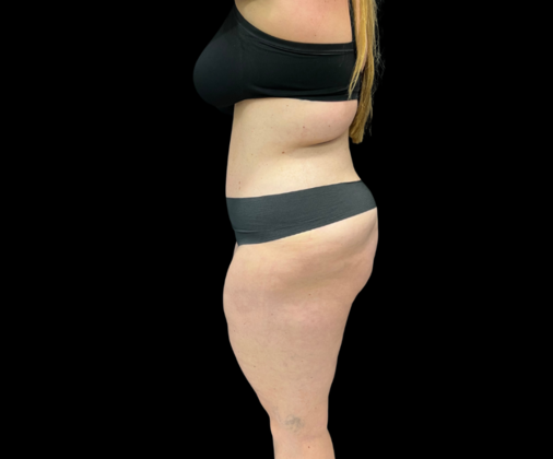 Tummy Tuck: Case 5 - After