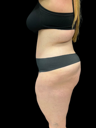 Tummy Tuck Tummy Tuck 4 - After