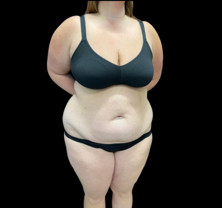 Tummy Tuck: Case 5 - Before