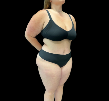 Tummy Tuck: Case 5 - After