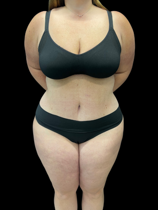 Liposuction Case 9 - After