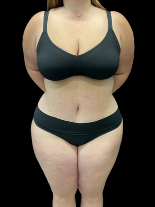 Liposuction Liposuction 2  - After