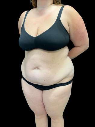 Liposuction: Liposuction 2 - Before
