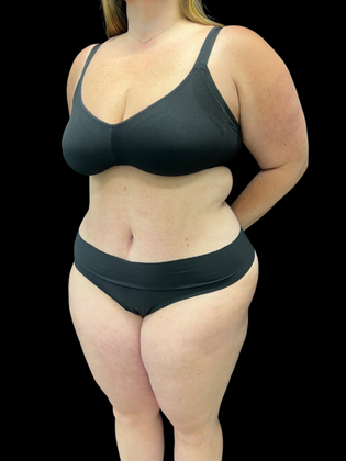 Liposuction: Liposuction 2 - After