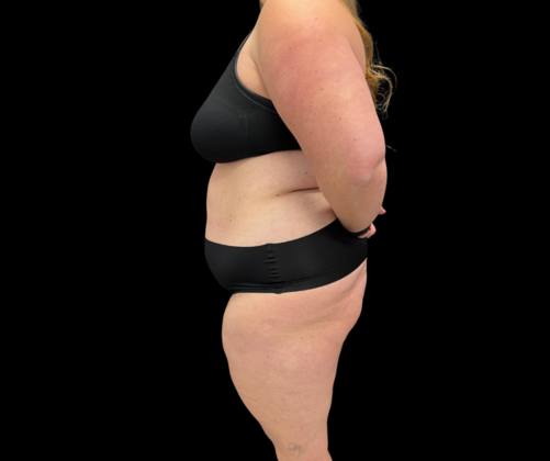 Liposuction: Case 9 - Before