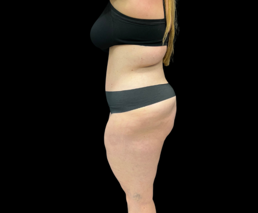 Liposuction: Case 9 - After