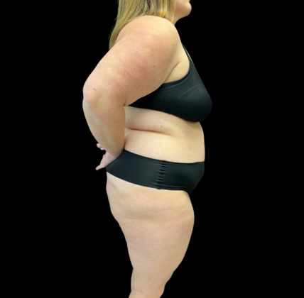 Liposuction: Case 9 - Before