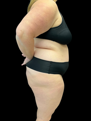 Liposuction: Liposuction 2 - Before