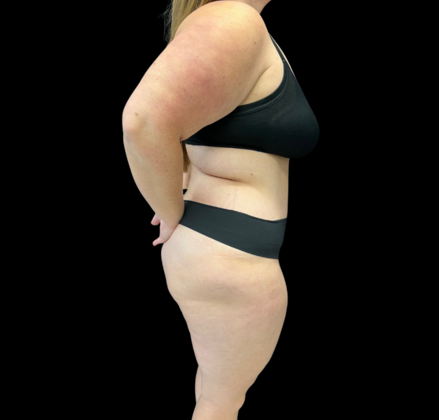 Liposuction: Case 9 - After