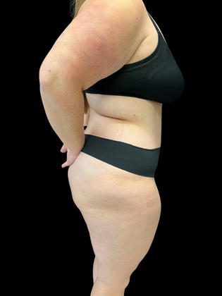 Liposuction: Liposuction 2 - After