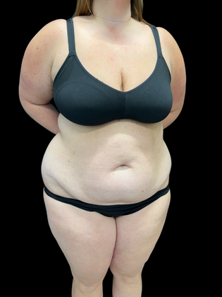 Liposuction: Liposuction 2 - Before
