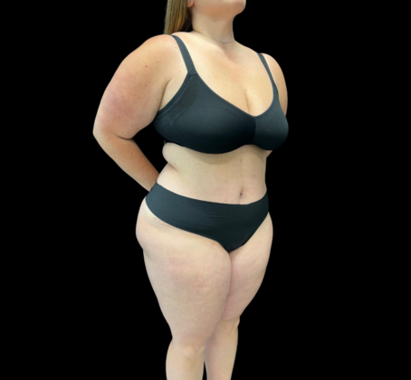 Liposuction: Case 9 - After