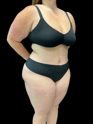 Liposuction: Liposuction 2 - After