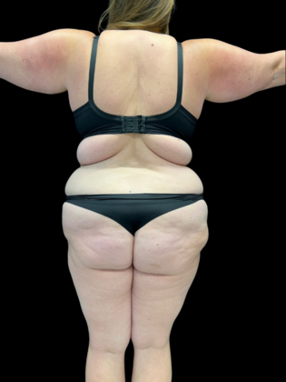 Liposuction: Case 9 - Before