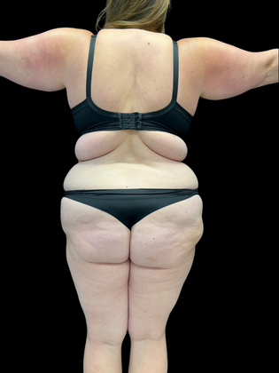 Liposuction: Liposuction 2 - Before