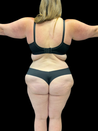 Liposuction: Case 9 - After