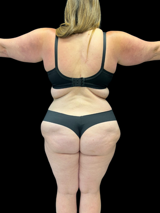 Liposuction: Liposuction 2 - After