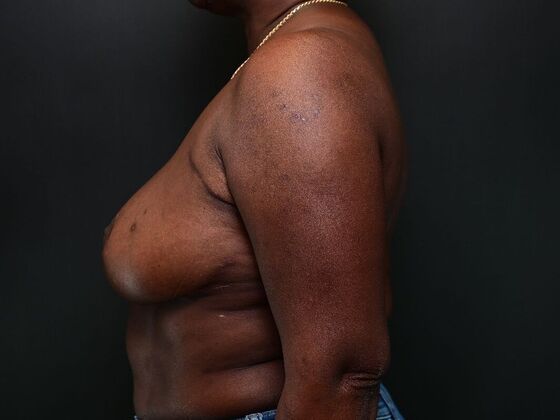 Breast Reconstruction: Case 4 - After