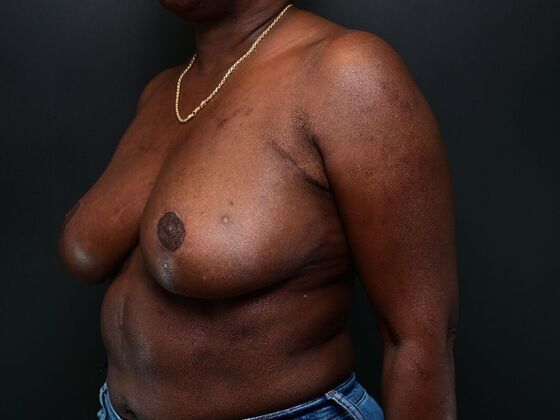 Breast Reconstruction: Case 4 - After