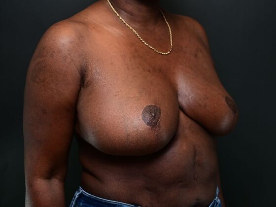 Breast Reconstruction Case 4 - After