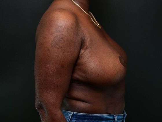 Breast Reconstruction: Case 4 - After